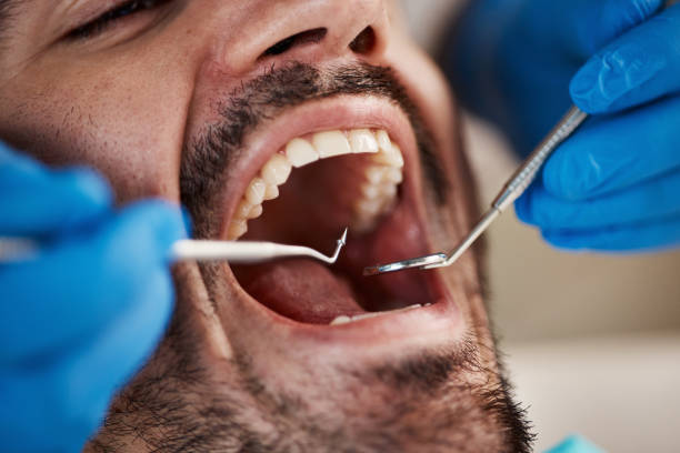 Best Emergency Wisdom Teeth Removal in Cedar City, UT