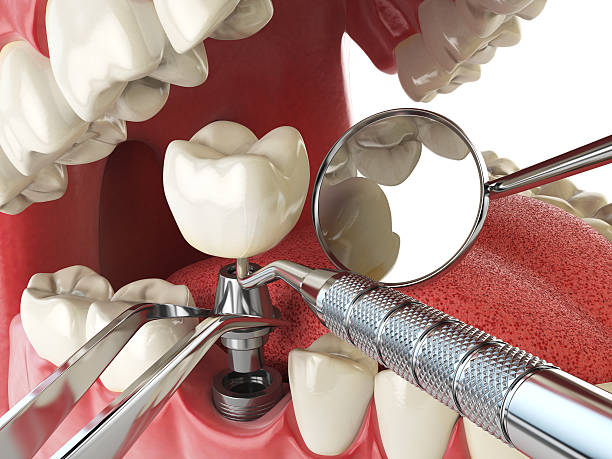 Best Emergency Treatment for Dental Infections or Abscesses in Cedar City, UT